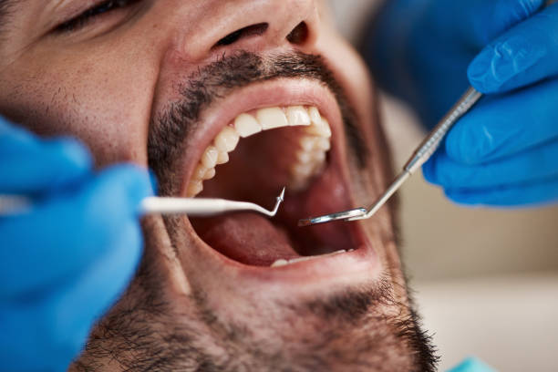 Best Emergency Wisdom Teeth Removal in Eagan, MN